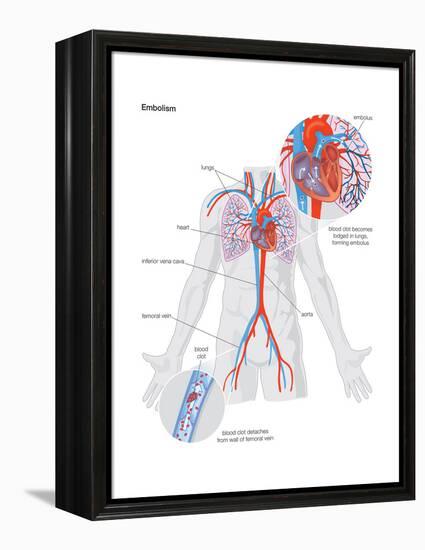 Embolism-Encyclopaedia Britannica-Framed Stretched Canvas