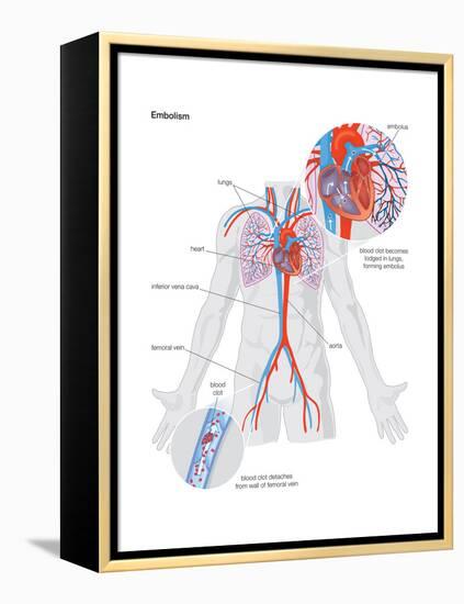 Embolism-Encyclopaedia Britannica-Framed Stretched Canvas