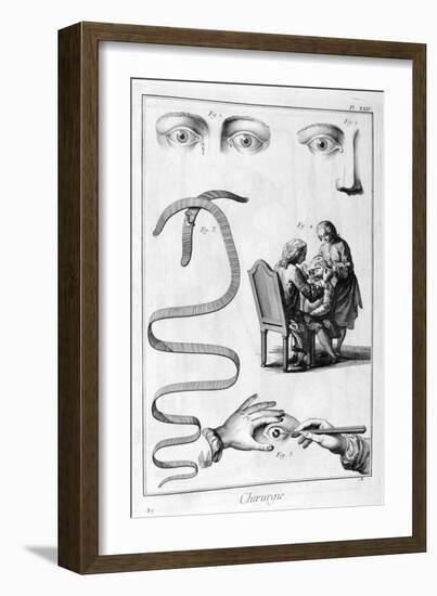 Eye Surgery, 1751-1777-Denis Diderot-Framed Giclee Print