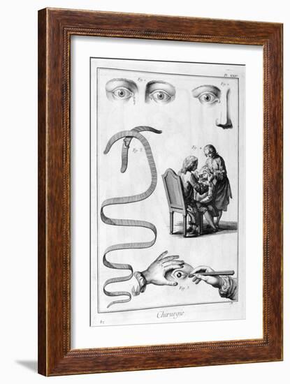 Eye Surgery, 1751-1777-Denis Diderot-Framed Giclee Print