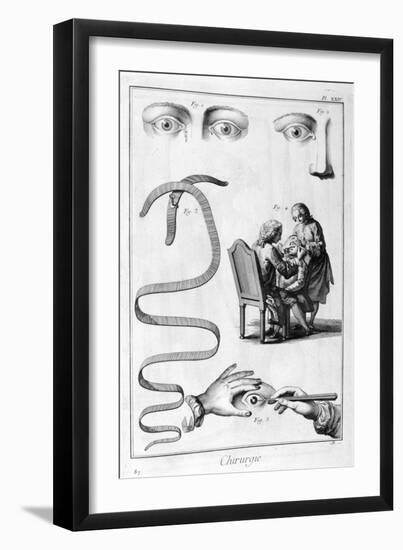 Eye Surgery, 1751-1777-Denis Diderot-Framed Giclee Print