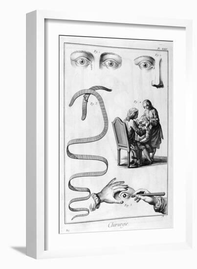 Eye Surgery, 1751-1777-Denis Diderot-Framed Giclee Print