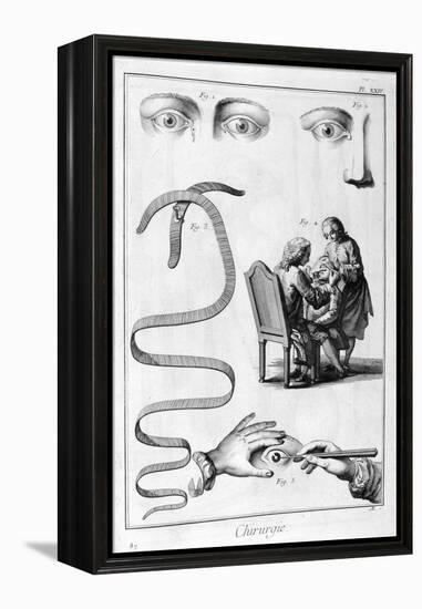 Eye Surgery, 1751-1777-Denis Diderot-Framed Premier Image Canvas