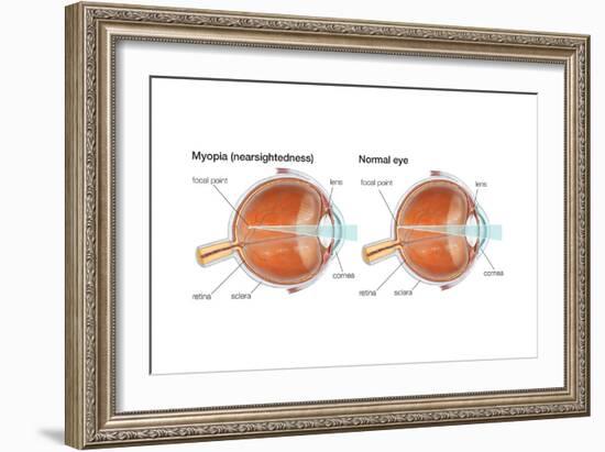 Farsighted Eye (Hyperopia). Convex Lens, Ophthalmology, Health and Disease-Encyclopaedia Britannica-Framed Art Print