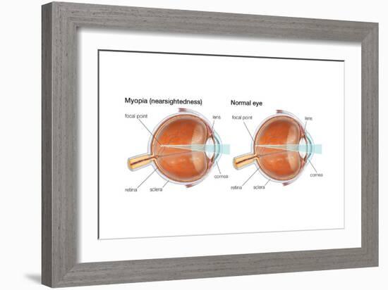 Farsighted Eye (Hyperopia). Convex Lens, Ophthalmology, Health and Disease-Encyclopaedia Britannica-Framed Art Print