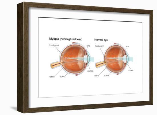 Farsighted Eye (Hyperopia). Convex Lens, Ophthalmology, Health and Disease-Encyclopaedia Britannica-Framed Art Print