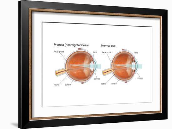 Farsighted Eye (Hyperopia). Convex Lens, Ophthalmology, Health and Disease-Encyclopaedia Britannica-Framed Art Print