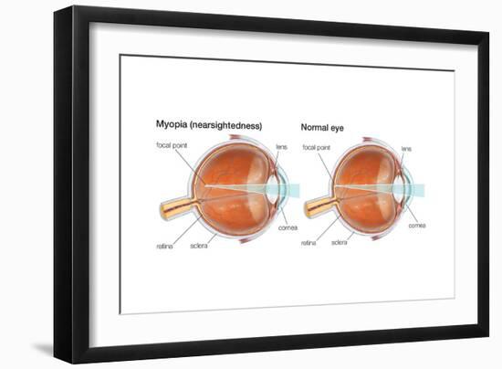 Farsighted Eye (Hyperopia). Convex Lens, Ophthalmology, Health and Disease-Encyclopaedia Britannica-Framed Art Print