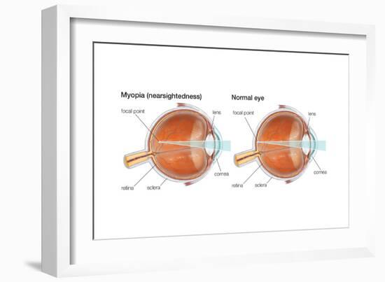 Farsighted Eye (Hyperopia). Convex Lens, Ophthalmology, Health and Disease-Encyclopaedia Britannica-Framed Art Print