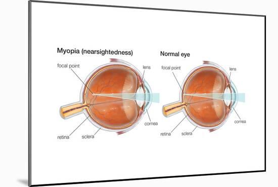 Farsighted Eye (Hyperopia). Convex Lens, Ophthalmology, Health and Disease-Encyclopaedia Britannica-Mounted Art Print