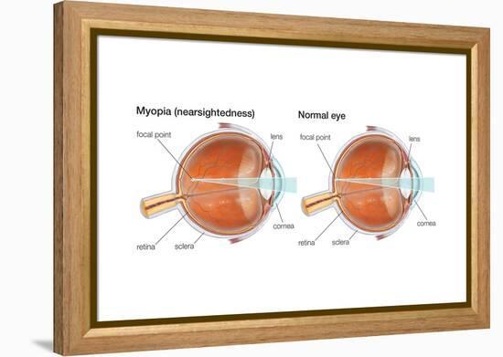 Farsighted Eye (Hyperopia). Convex Lens, Ophthalmology, Health and Disease-Encyclopaedia Britannica-Framed Stretched Canvas