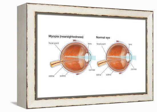 Farsighted Eye (Hyperopia). Convex Lens, Ophthalmology, Health and Disease-Encyclopaedia Britannica-Framed Stretched Canvas