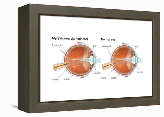 Farsighted Eye (Hyperopia). Convex Lens, Ophthalmology, Health and Disease-Encyclopaedia Britannica-Framed Stretched Canvas