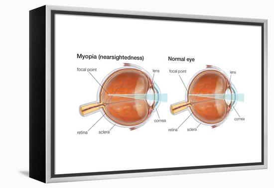 Farsighted Eye (Hyperopia). Convex Lens, Ophthalmology, Health and Disease-Encyclopaedia Britannica-Framed Stretched Canvas