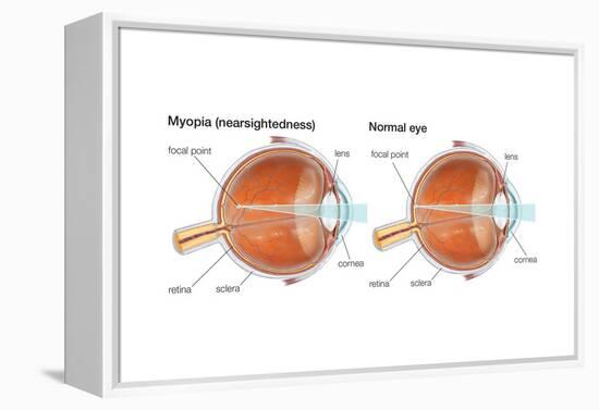 Farsighted Eye (Hyperopia). Convex Lens, Ophthalmology, Health and Disease-Encyclopaedia Britannica-Framed Stretched Canvas