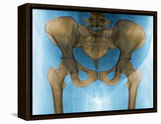 Female Pelvis, X-ray-Du Cane Medical-Framed Premier Image Canvas