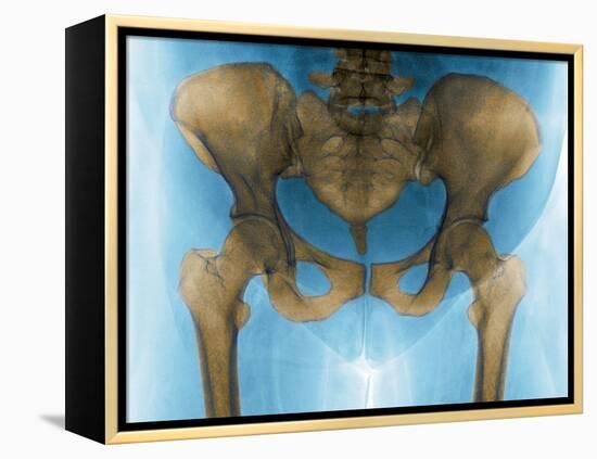 Female Pelvis, X-ray-Du Cane Medical-Framed Premier Image Canvas