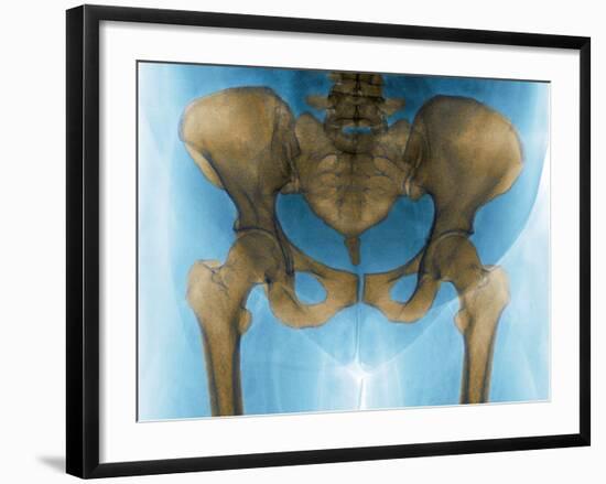 Female Pelvis, X-ray-Du Cane Medical-Framed Photographic Print