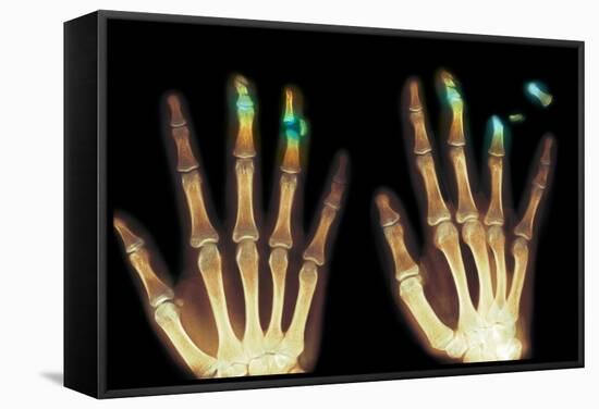 Fingertip Laceration Injuries, X-rays-Du Cane Medical-Framed Premier Image Canvas