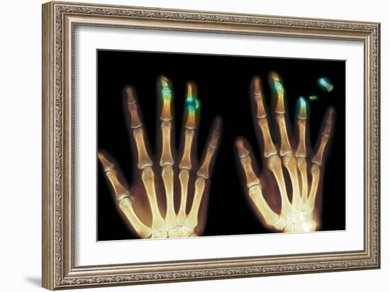 Fingertip Laceration Injuries, X-rays-Du Cane Medical-Framed Photographic Print