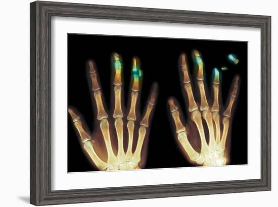 Fingertip Laceration Injuries, X-rays-Du Cane Medical-Framed Photographic Print