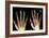 Fingertip Laceration Injuries, X-rays-Du Cane Medical-Framed Photographic Print