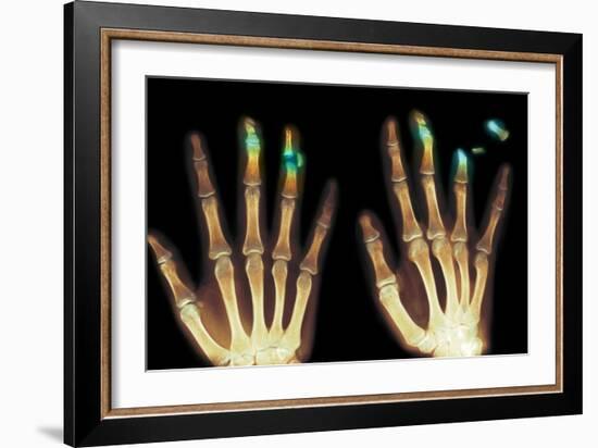 Fingertip Laceration Injuries, X-rays-Du Cane Medical-Framed Photographic Print