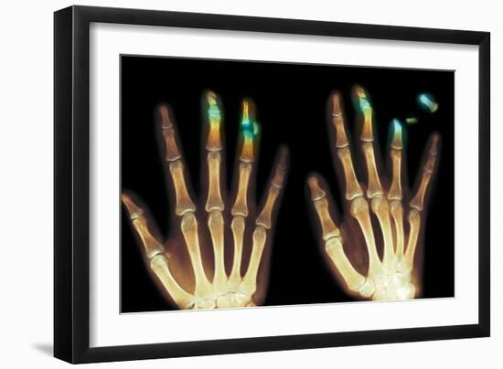 Fingertip Laceration Injuries, X-rays-Du Cane Medical-Framed Photographic Print