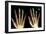 Fingertip Laceration Injuries, X-rays-Du Cane Medical-Framed Photographic Print