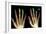 Fingertip Laceration Injuries, X-rays-Du Cane Medical-Framed Photographic Print