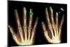 Fingertip Laceration Injuries, X-rays-Du Cane Medical-Mounted Photographic Print