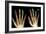 Fingertip Laceration Injuries, X-rays-Du Cane Medical-Framed Photographic Print