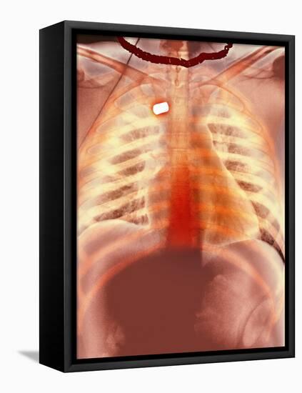 Firearm Injury, X-ray-Du Cane Medical-Framed Premier Image Canvas