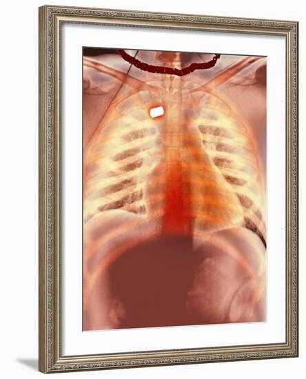 Firearm Injury, X-ray-Du Cane Medical-Framed Photographic Print