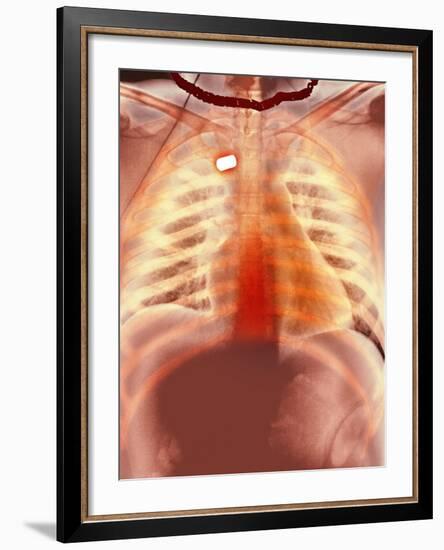 Firearm Injury, X-ray-Du Cane Medical-Framed Photographic Print