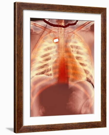 Firearm Injury, X-ray-Du Cane Medical-Framed Photographic Print