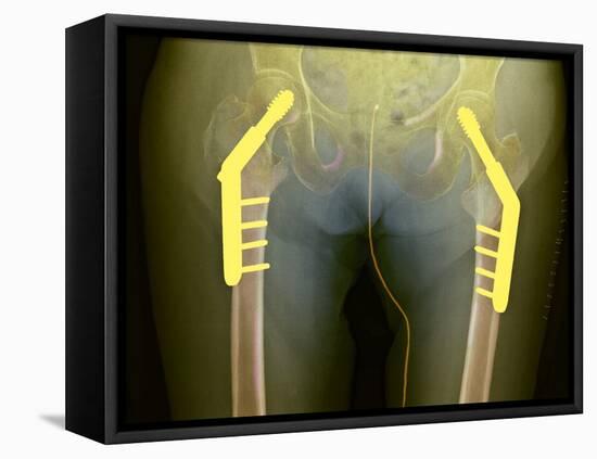 Fixed Double Hip Fracture (image 2 of 2)-Du Cane Medical-Framed Premier Image Canvas