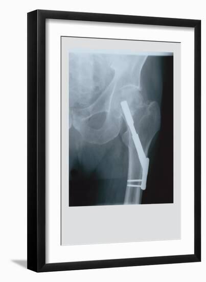 Fixed Femur-null-Framed Art Print