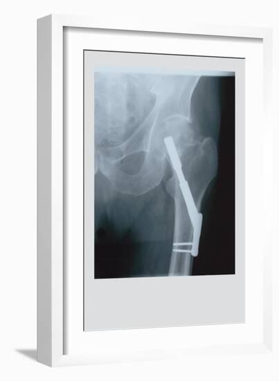 Fixed Femur--Framed Art Print