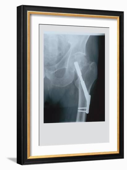 Fixed Femur-null-Framed Art Print