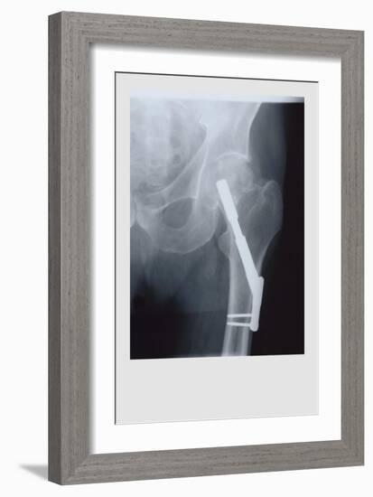 Fixed Femur-null-Framed Premium Giclee Print