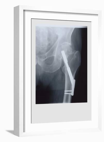 Fixed Femur-null-Framed Premium Giclee Print