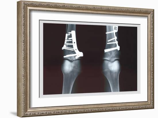 Fixed Tibia-null-Framed Art Print