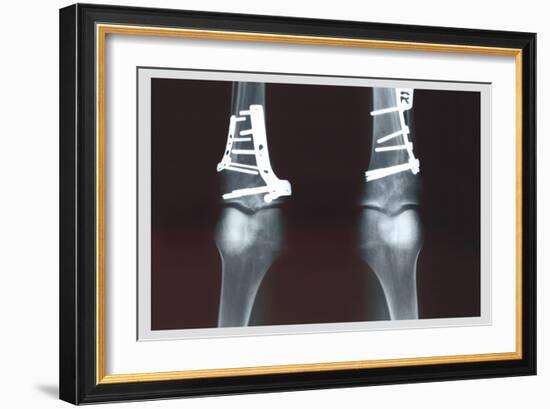 Fixed Tibia-null-Framed Art Print