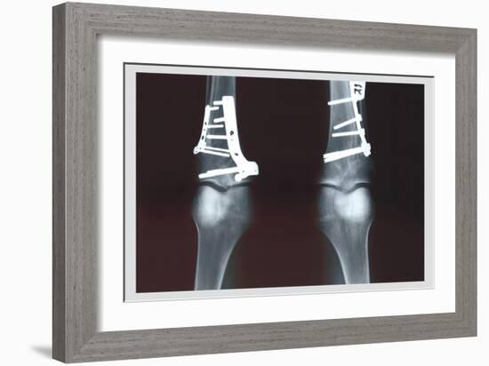 Fixed Tibia-null-Framed Premium Giclee Print