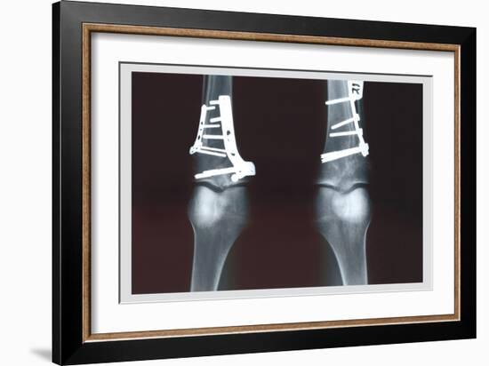 Fixed Tibia-null-Framed Premium Giclee Print