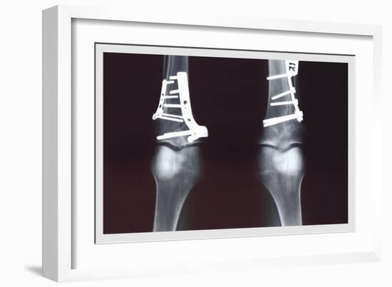 Fixed Tibia-null-Framed Premium Giclee Print