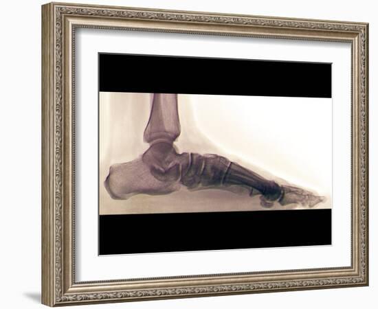 Flat Foot, X-ray-ZEPHYR-Framed Photographic Print