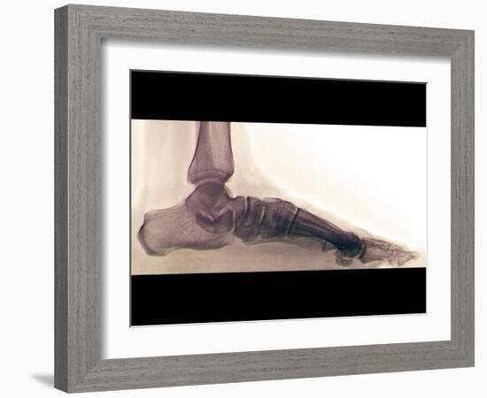 Flat Foot, X-ray-ZEPHYR-Framed Photographic Print