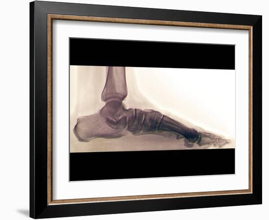 Flat Foot, X-ray-ZEPHYR-Framed Photographic Print